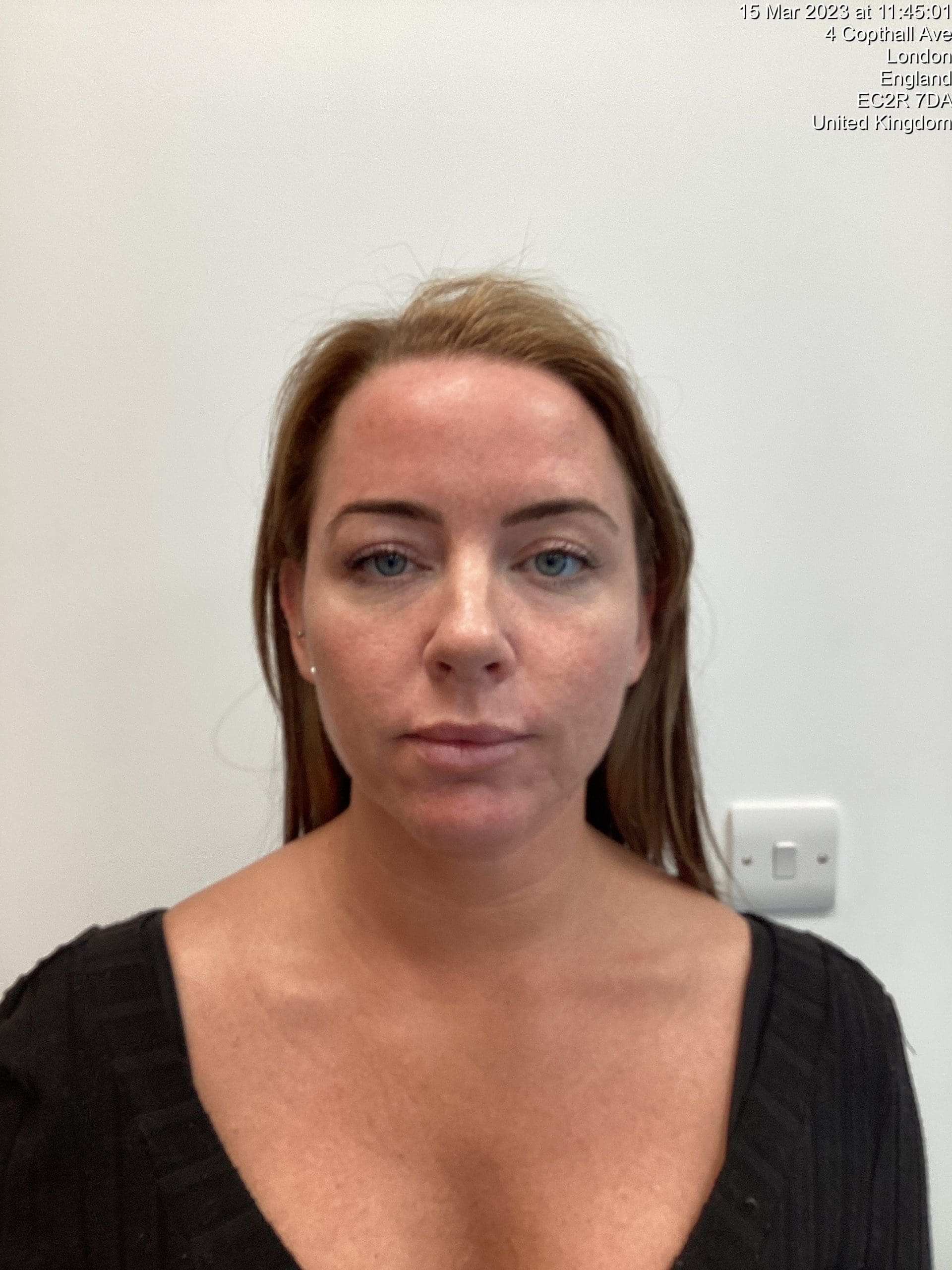 Enhance mid-face definition with cheek filler