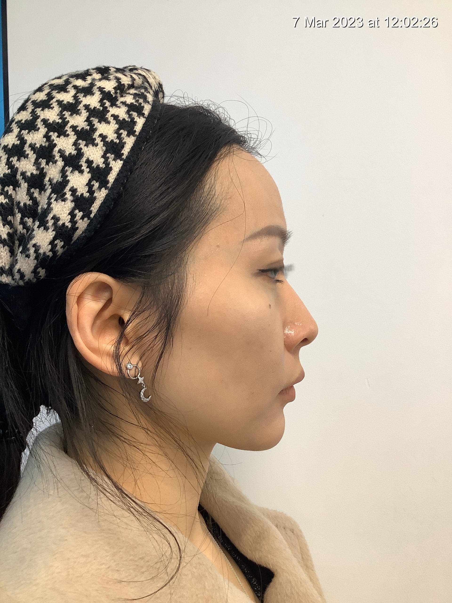 Patient discussing chin filler suitability with Dr Mirali in a South London clinic