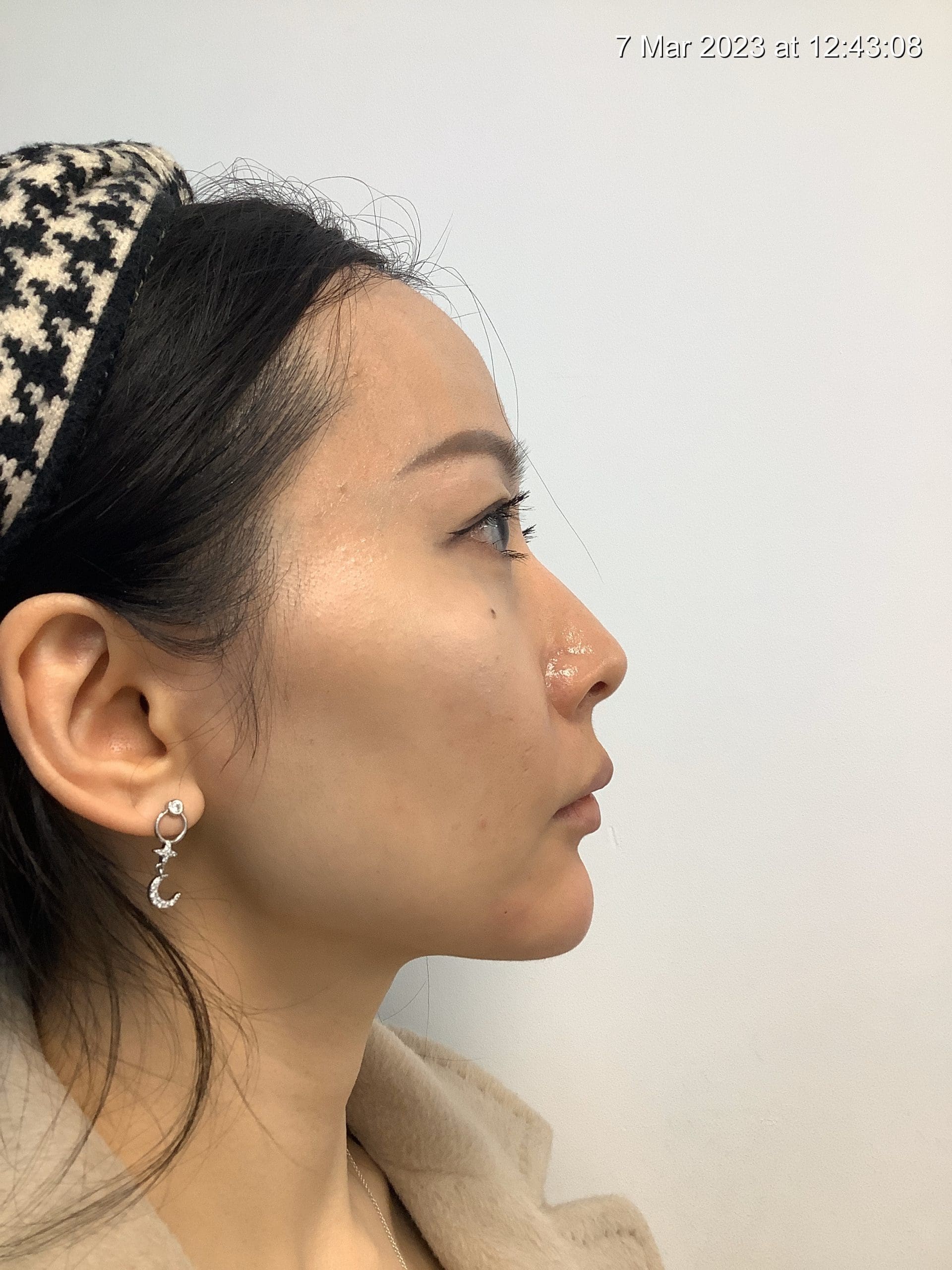 Refine your profile with chin filler in Streatham & Sydenham. Doctor-led hyaluronic acid contouring for balanced, natural results at our South London clinics.