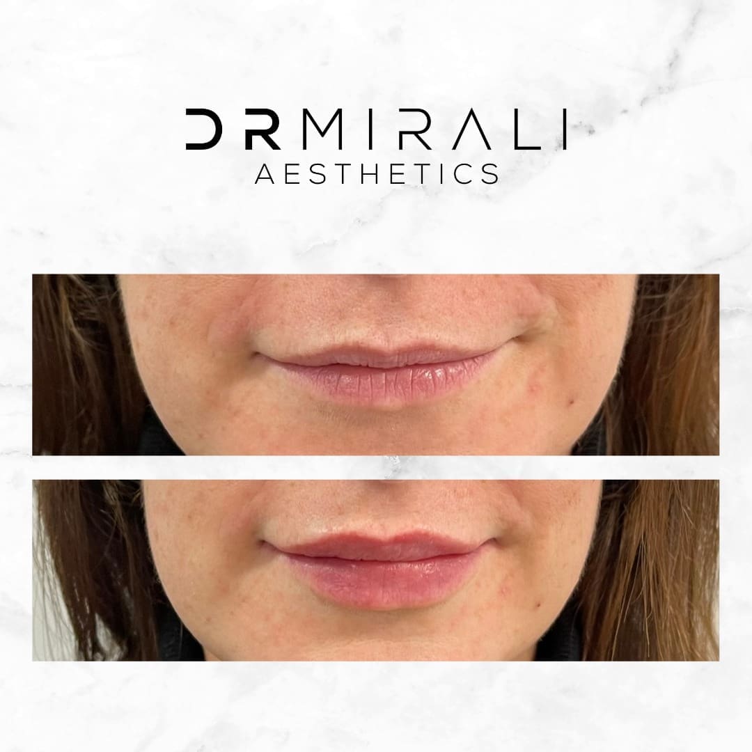 Lip filler results at Dr Mirali Aesthetics Streatham