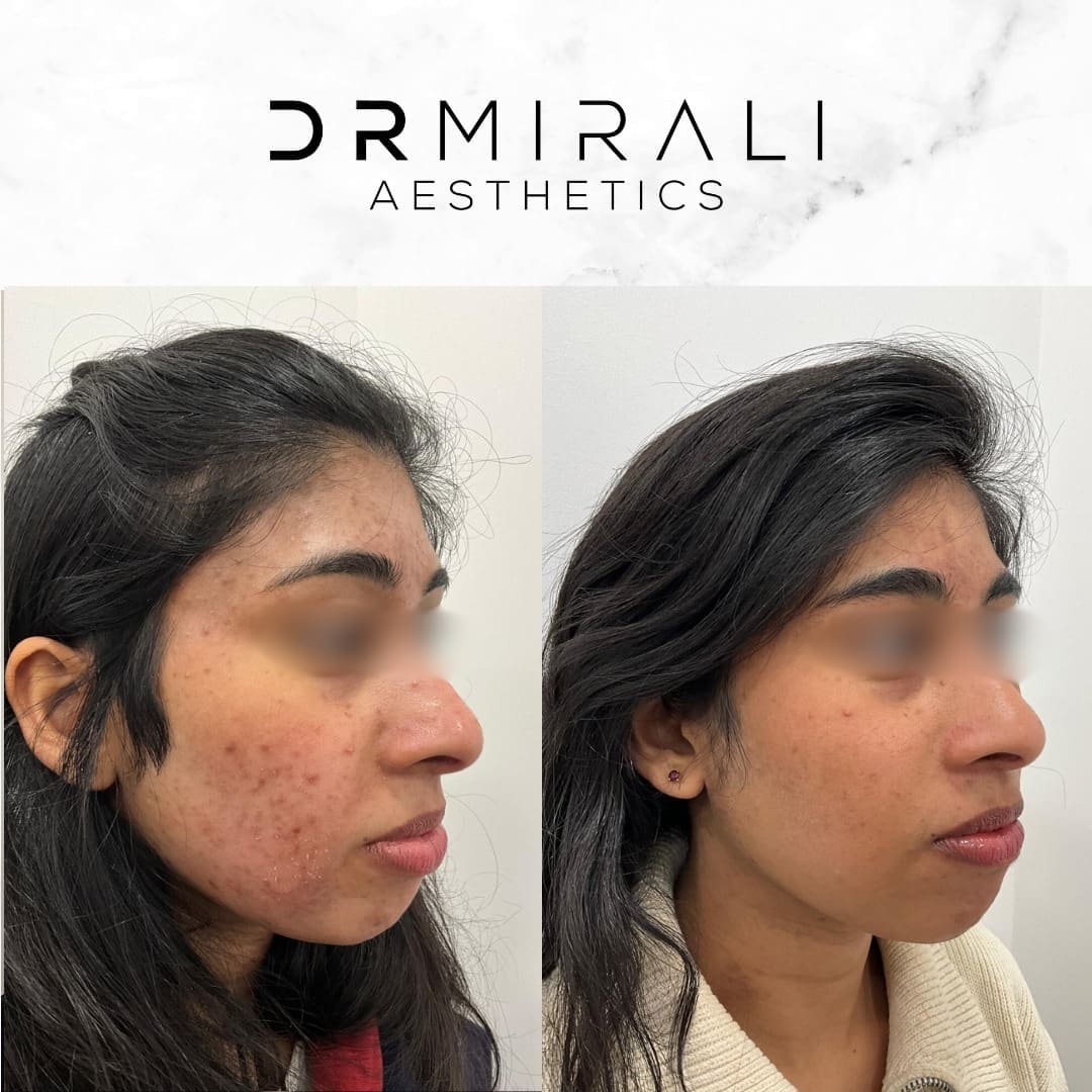 Patient receiving Obagi Blue Peel Radiance treatment at Dr Mirali Aesthetics South London clinic