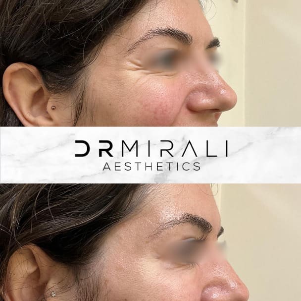 Crow's Feet Lines results at Dr Mirali Aesthetics Streatham
