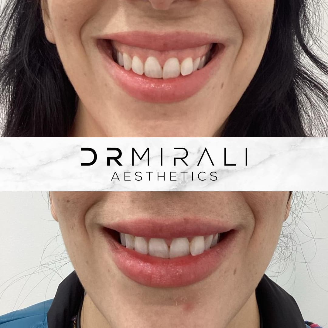 Gummy smile correction in Streatham – Dr Mirali Aesthetics