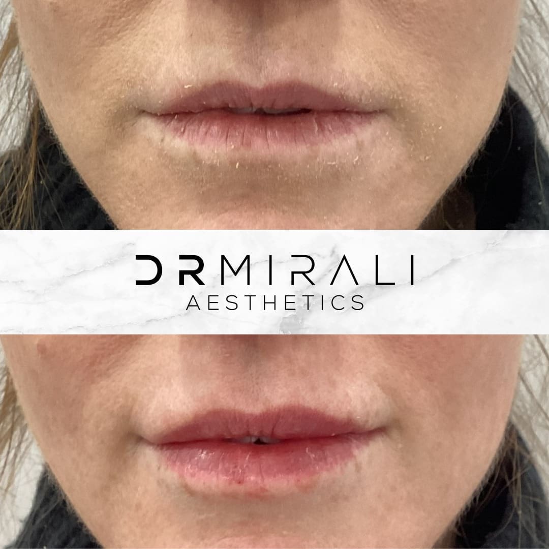 Lip filler results at Dr Mirali Aesthetics Streatham