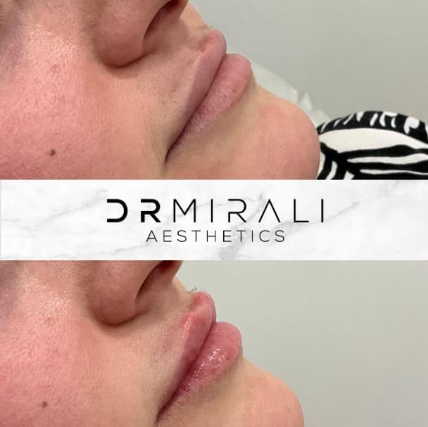 Enhance shape, symmetry and hydration with lip filler in Streatham and Sydenham. Doctor-led hyaluronic acid treatment for natural results at our South London clinics.
