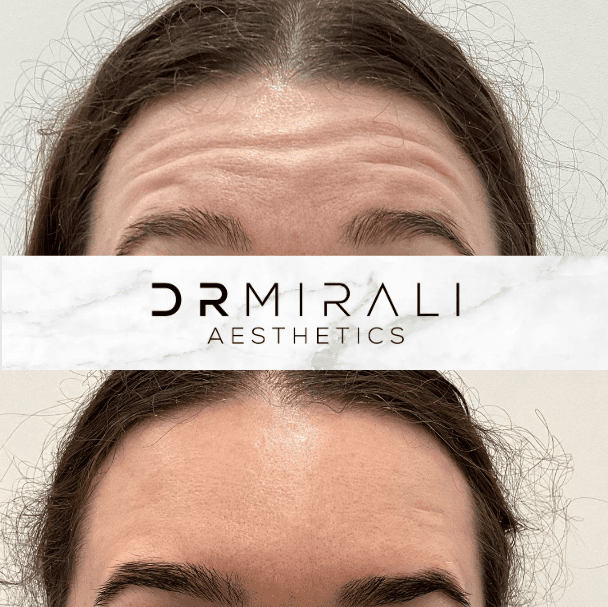 Smiling patient showing smooth, line-free skin after Botox