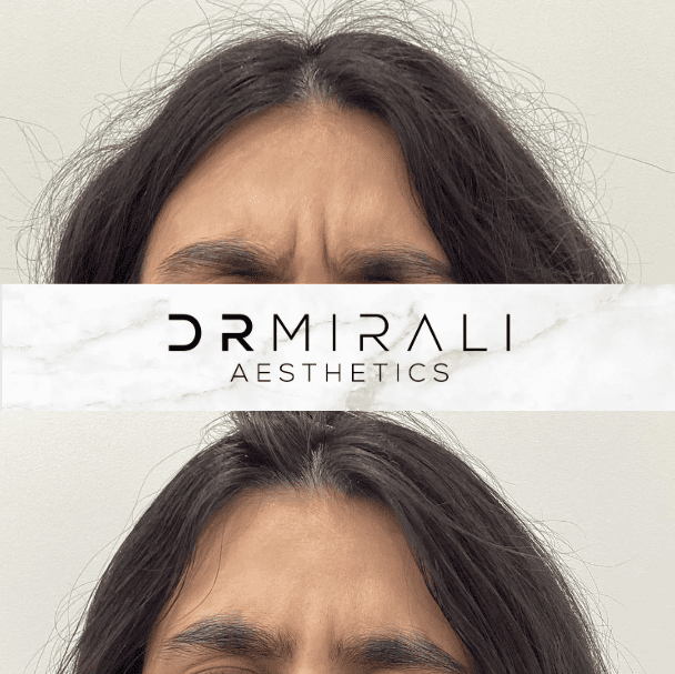 Frown Line results at Dr Mirali Aesthetics Streatham
