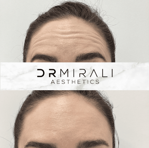 Dr Mirali Aesthetics Forehead Lines Dr Mirali consulting with a patient about anti-wrinkle injections in a South London clinic