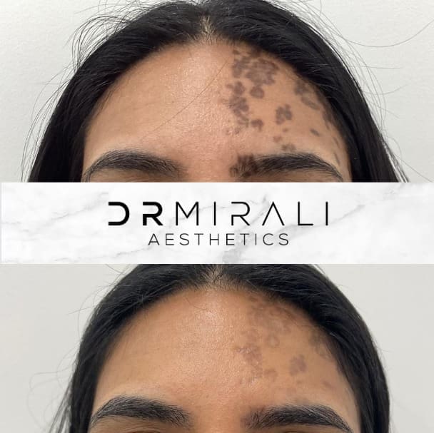 Face Mesotherapy treatment at Dr Mirali Aesthetics