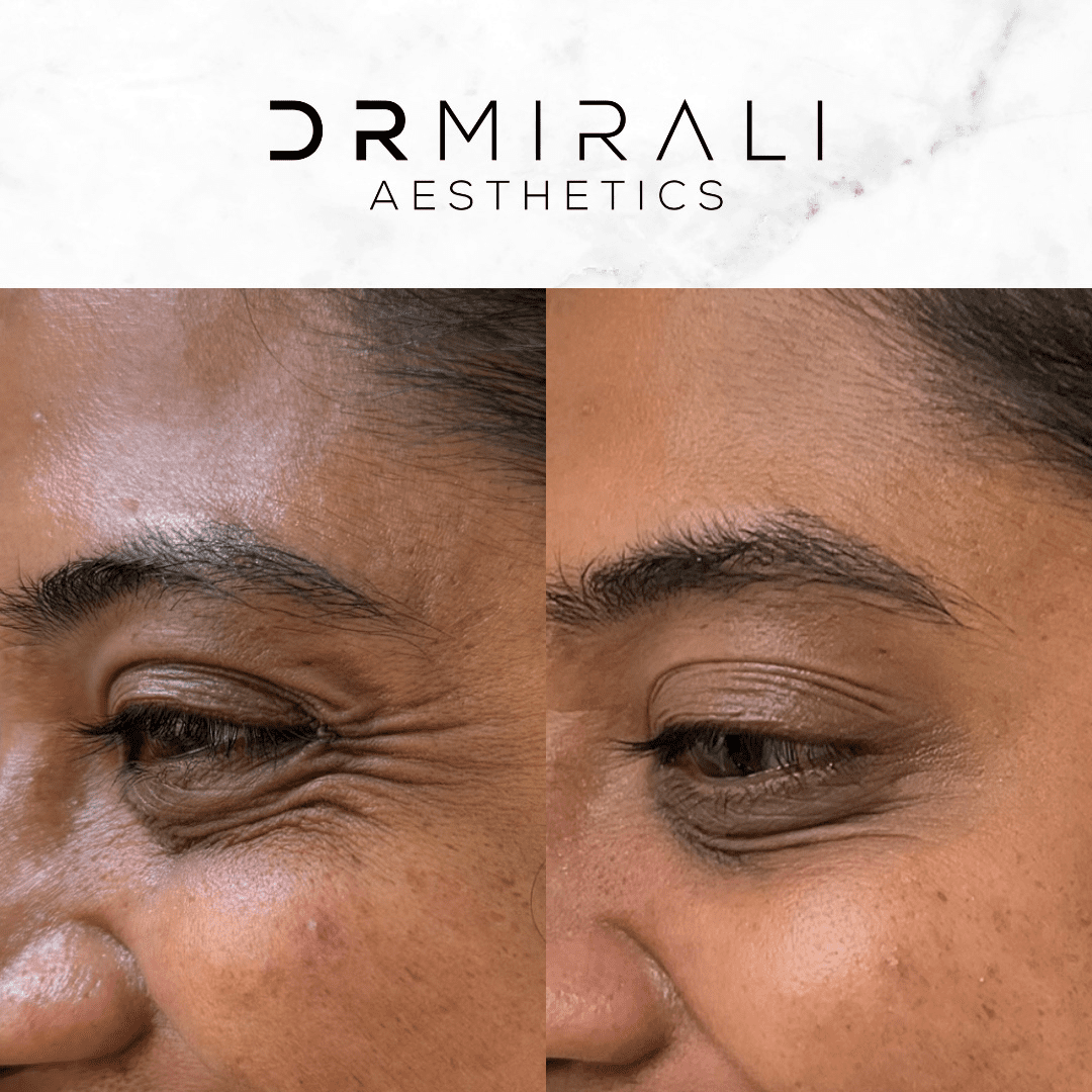 Soften crow’s feet (eye smile lines) with a personalised plan at Dr Mirali Aesthetics. Crow’s feet treatment in Streatham and Sydenham for natural, doctor-led results at our South London clinics.