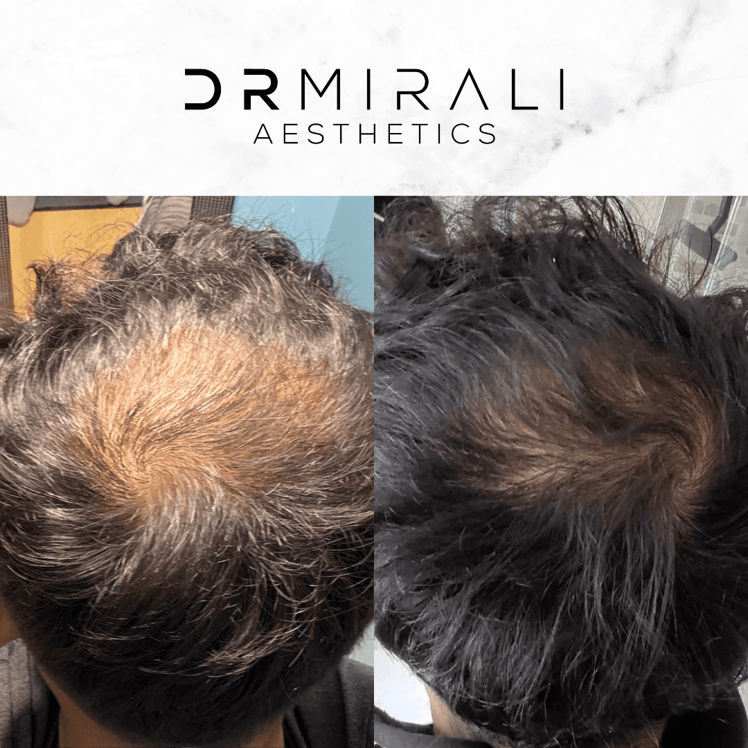 Exosome hair treatment in Streatham & Sydenham to support scalp health and hair quality. Doctor-led protocols at our South London clinics