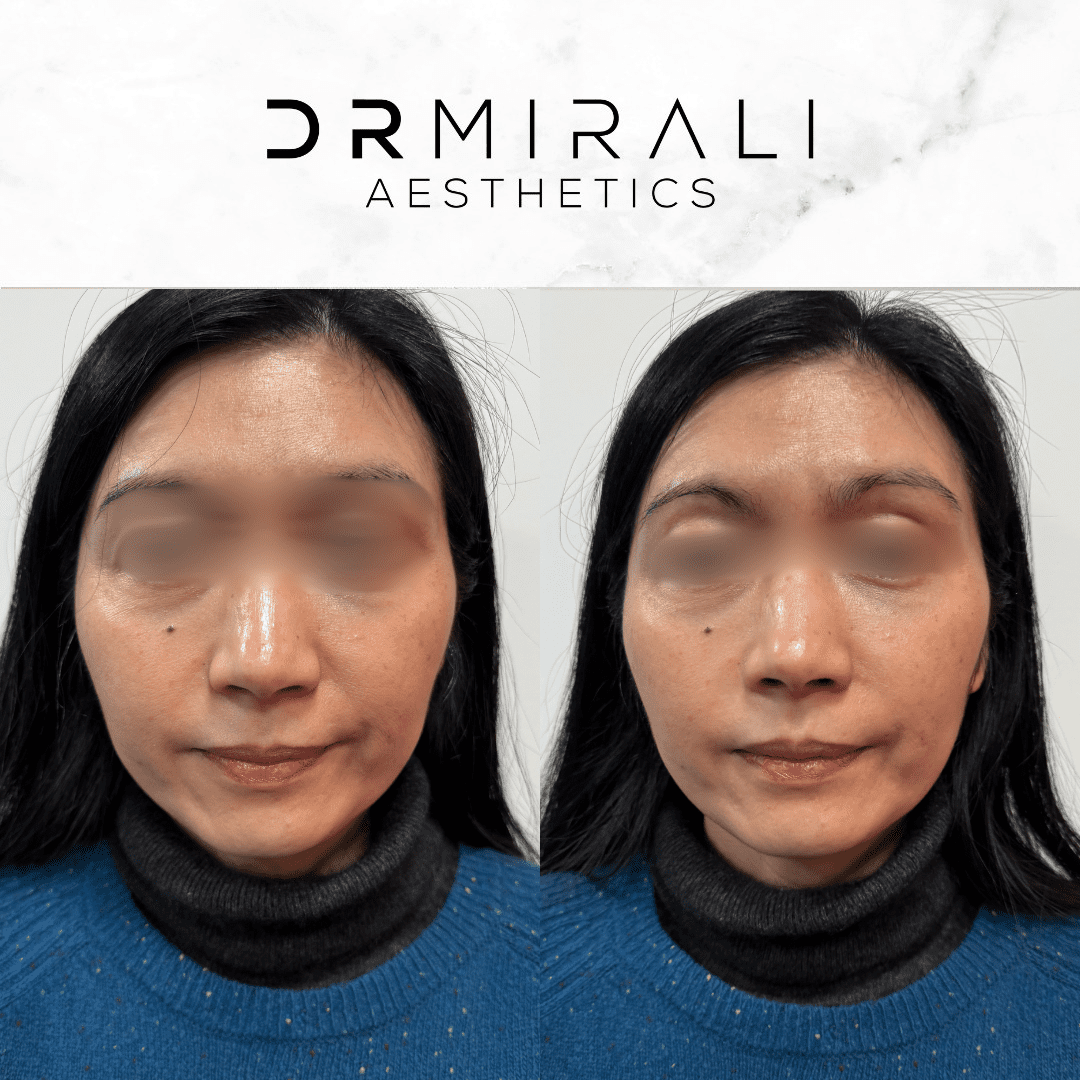 Doctor treating peri-oral lines at South London aesthetic clinic