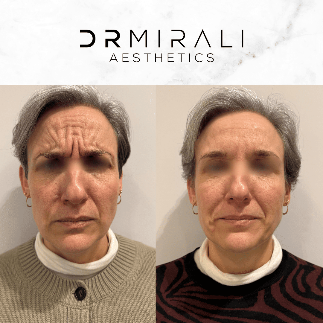 Forehead Line Treatment